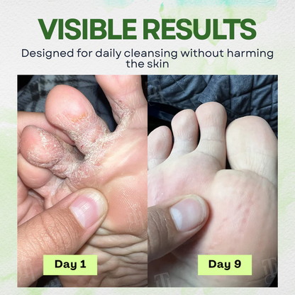 Kill Spores with Cvreoz®: The Defense Soap Bar for Unmatched Fungal Relief